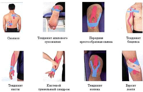 Схема тейпирования колена при болях